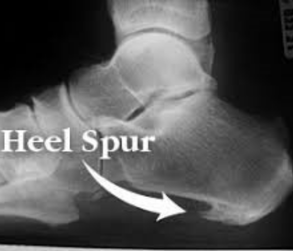 Heel Spur Syndrome Denton Foot And Ankle Surgical Specialists