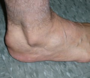 Heel Spur Syndrome - Denton Foot & Ankle Surgical Specialists